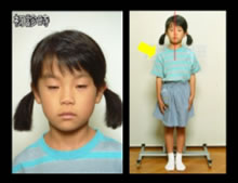 写真:態癖により歪んだ全身例