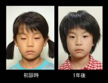 写真:態癖改善と矯正治療後