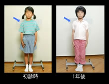 写真:態癖改善と矯正治療後