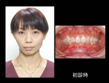 写真:態癖により歪んだ歯並び例