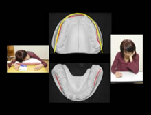 写真:態癖により歪んだ歯並び例