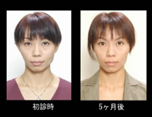 写真:態癖改善と矯正治療後