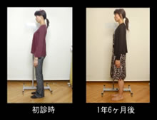 写真:態癖改善と矯正治療後