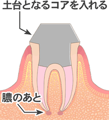 図：歯根治療の流れ