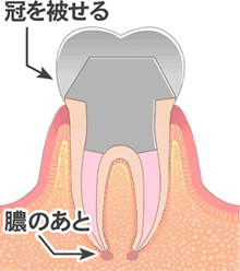 図：歯根治療の流れ
